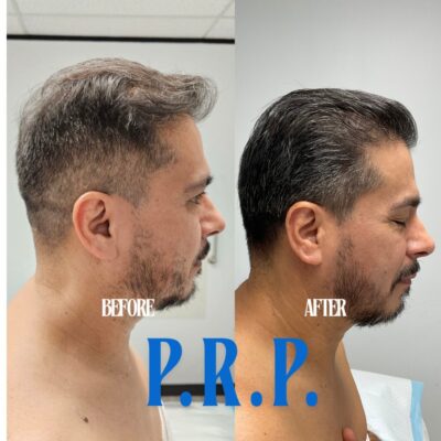 Platelet Rich Plasma (PRP) 1 hair loss treatment men women houston