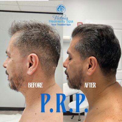 Platelet Rich Plasma (PRP) 2 hair loss treatment men women houston