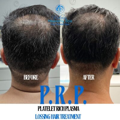 Platelet Rich Plasma (PRP) 3 hair loss treatment men women houston medical spa