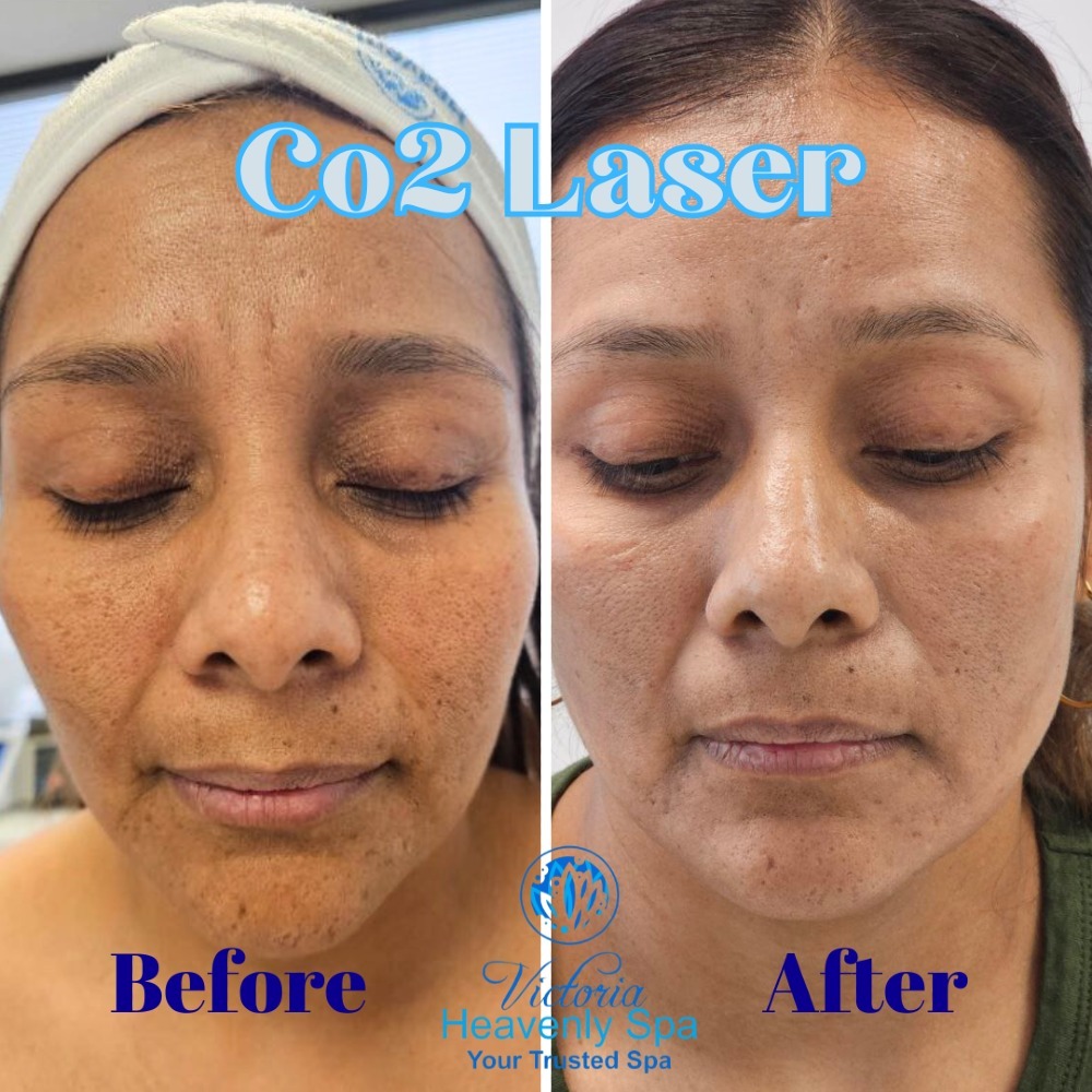 co2 laser treatment face houston